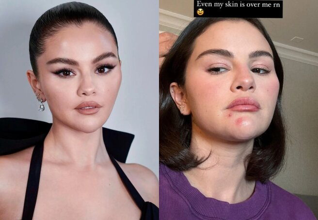 Selena Gomez Shows Off Her Face Without Makeup and With Acne