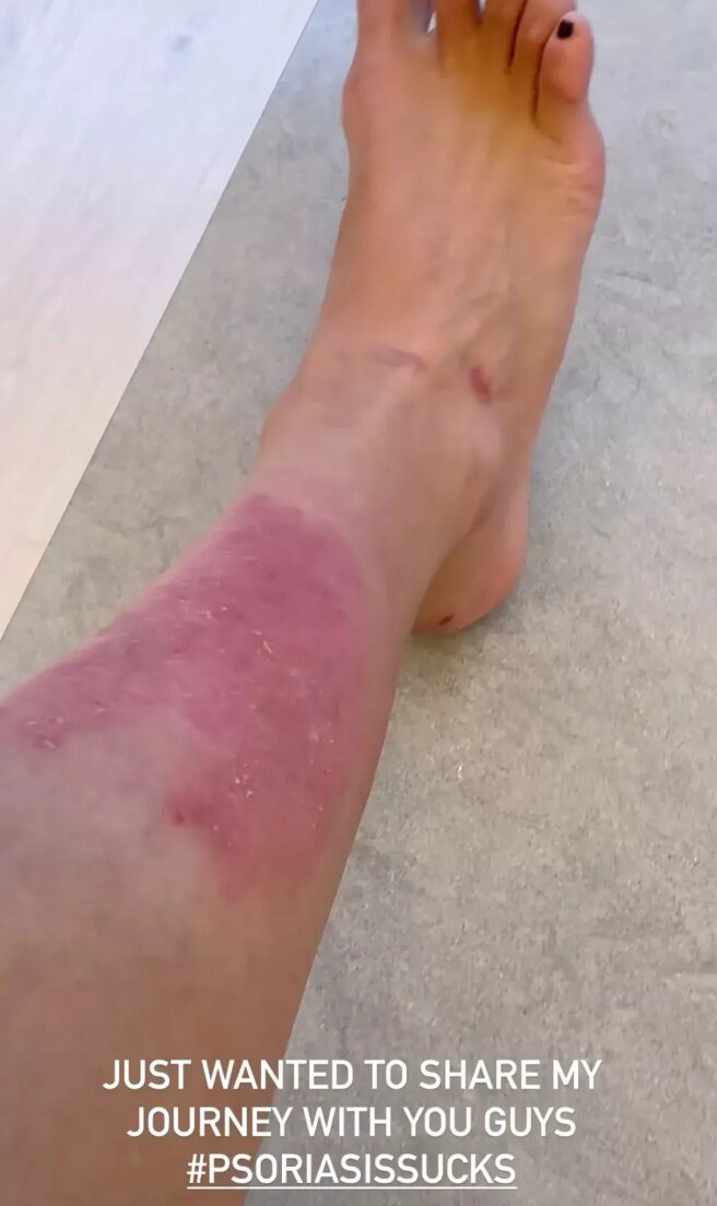 Болезнь на ноге Ким Кардашьян