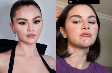 Selena Gomez Shows Off Her Face Without Makeup and With Acne